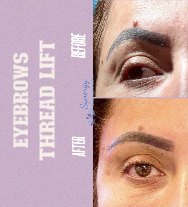 Eyebrow thread lift before and after