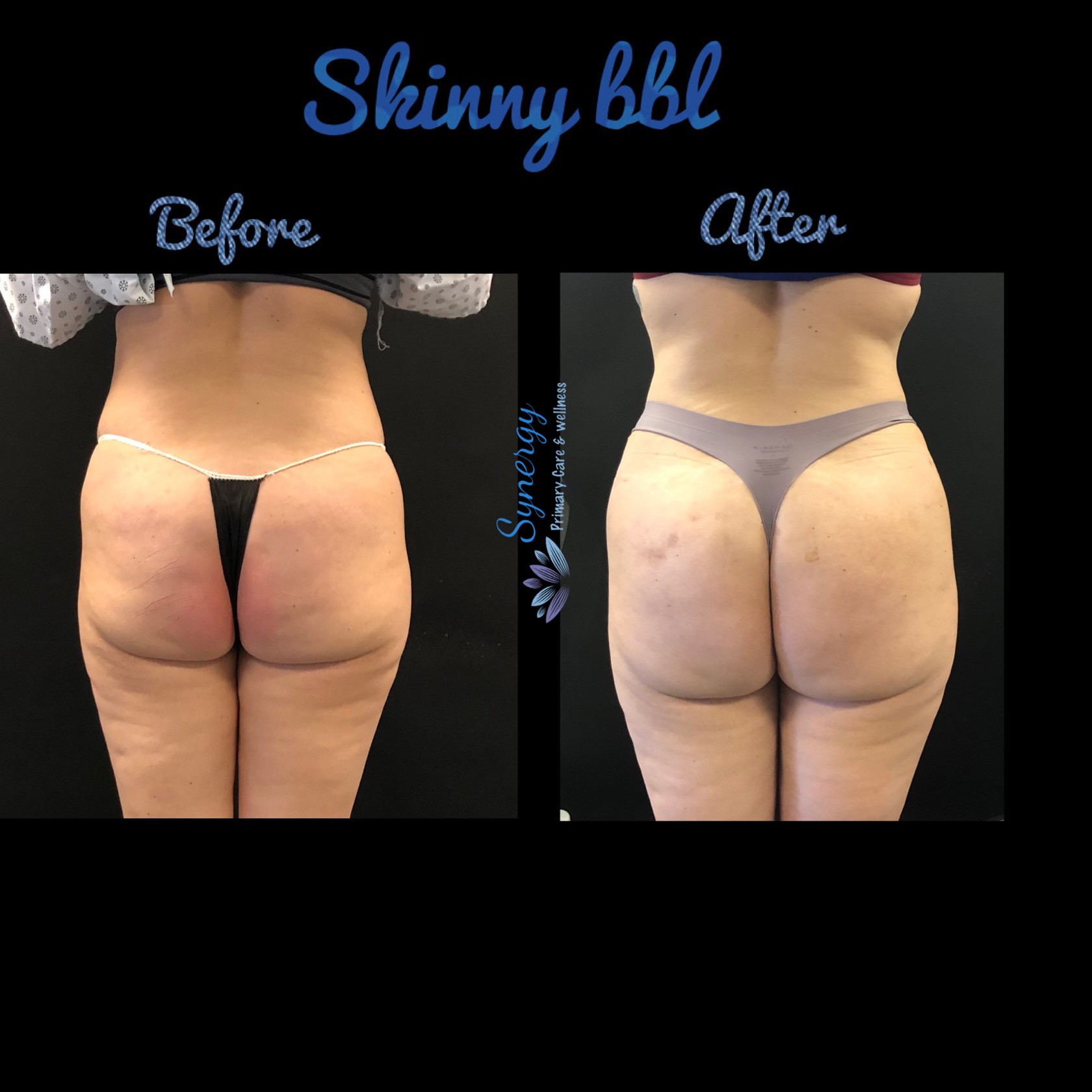 Cellulite reduction and body reshaping with beautifill by alma