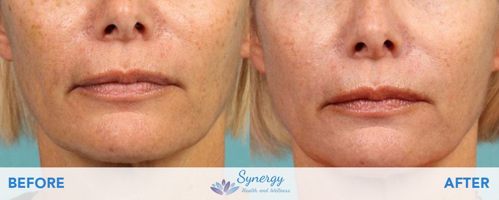 IPL Facial Rejuvenation Before and After at Synergy Health and Wellness