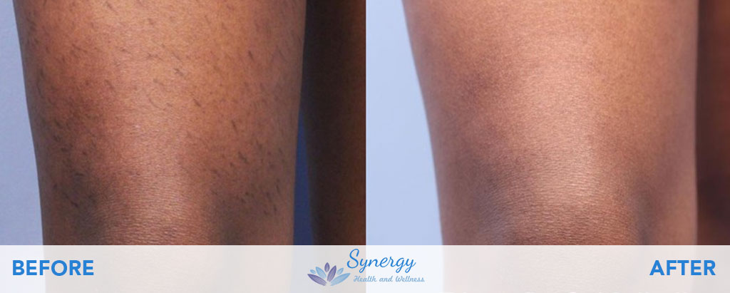Laser Hair Removal Before and After at Synergy Health and Wellness
