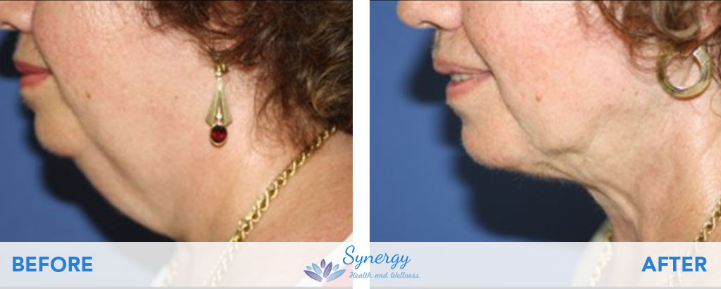 BeautiFill Laser Liposuction and Fat Grafting at Synergy Health and Wellness on Chin