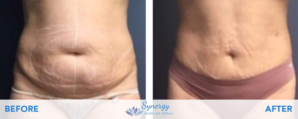 BeautiFill Laser Liposuction and Fat Grafting at Synergy Health and Wellness on Stomach
