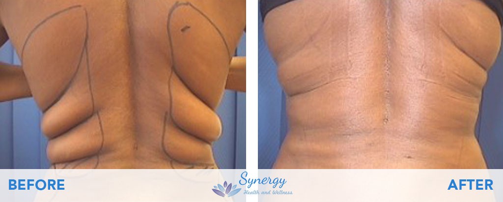 BeautiFill Laser Liposuction and Fat Grafting at Synergy Health and Wellness on Back Fat