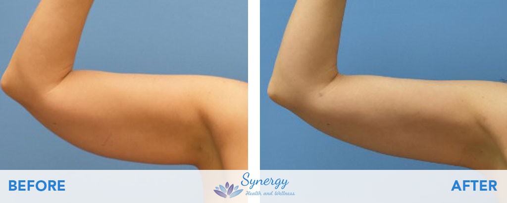 BeautiFill Laser Liposuction and Fat Grafting at Synergy Health and Wellness on Arms