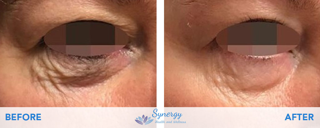 IPL Skin Rejuvenation Before and After on the Eyes