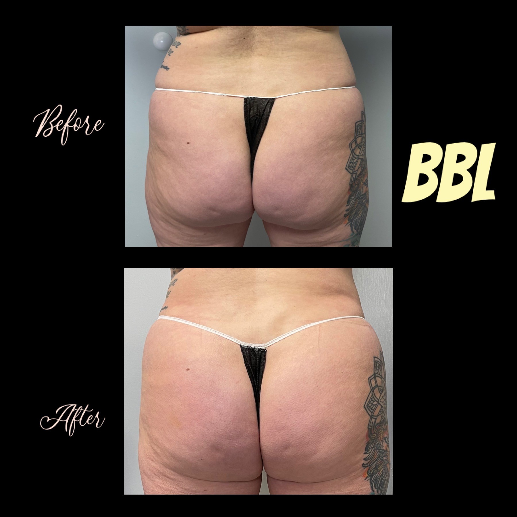 BBL Before and After