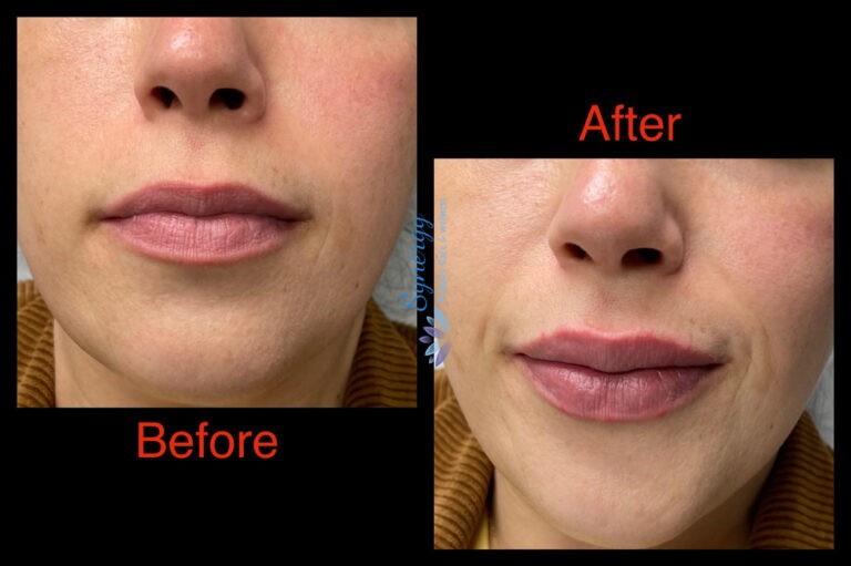 Lip injection before and after